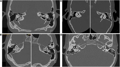 Novel POU3F4 variants identified in patients with inner ear malformations exhibit aberrant cellular distribution and lack of SLC6A20 transcriptional upregulation